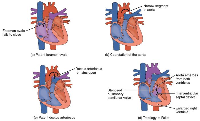 Nclex questions congenital heart defects