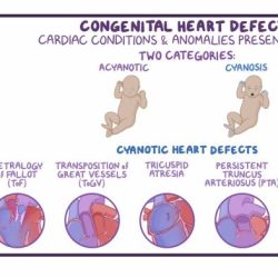 Nclex questions congenital heart defects