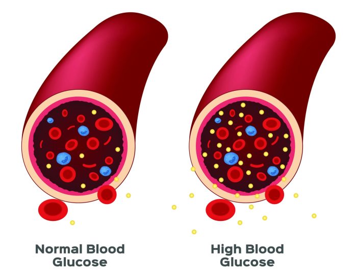 Sugar blood causes high hypoglycemia diabetes reactive symptoms fasting low right glucose cycle levels eat do wordpress management